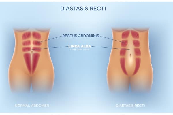 What Non-Surgical Options Are Available for Diastasis Recti Rayleigh?