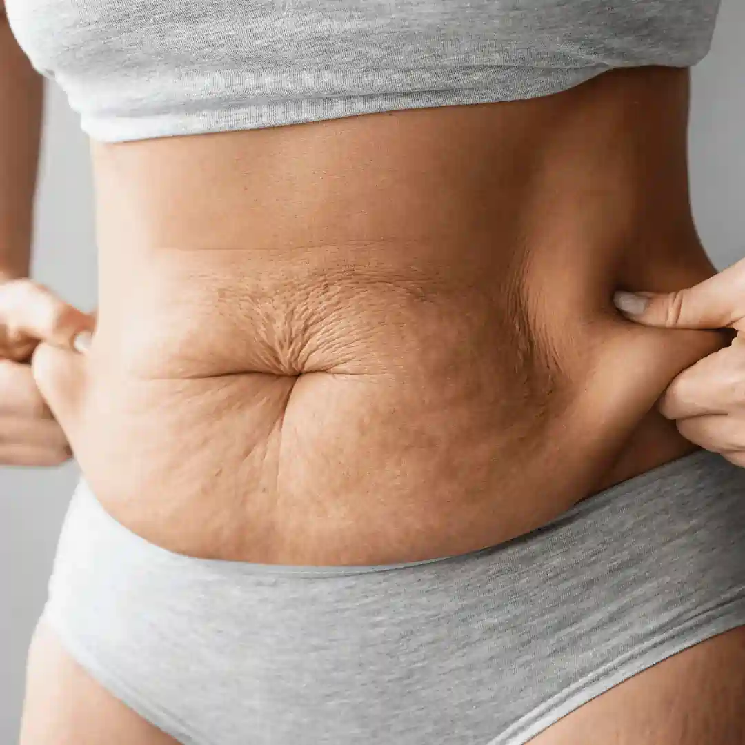 Is It Normal to Have Loose Skin After Pregnancy Rayleigh?