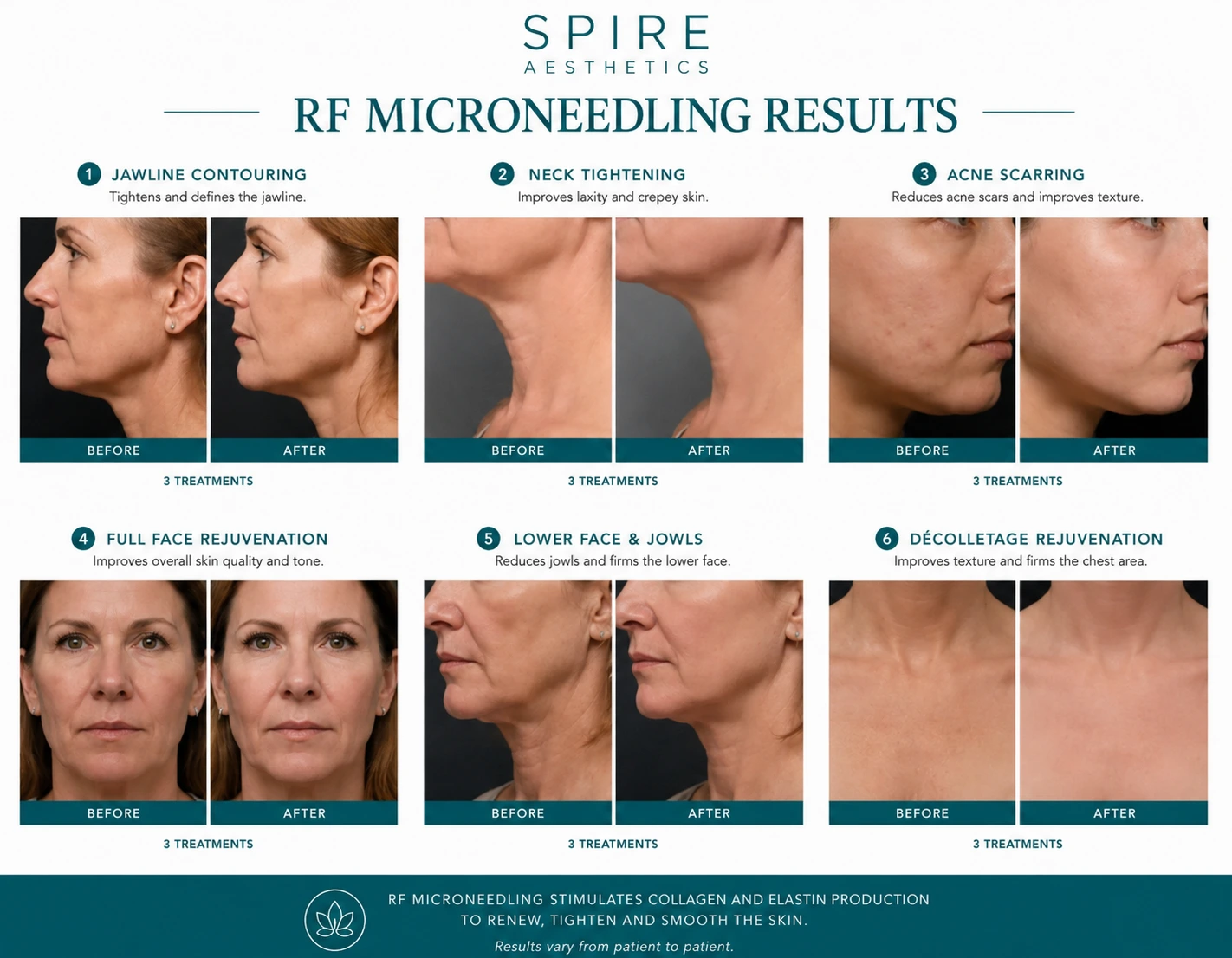 RF Microneedling Skin tightening Rayleigh results