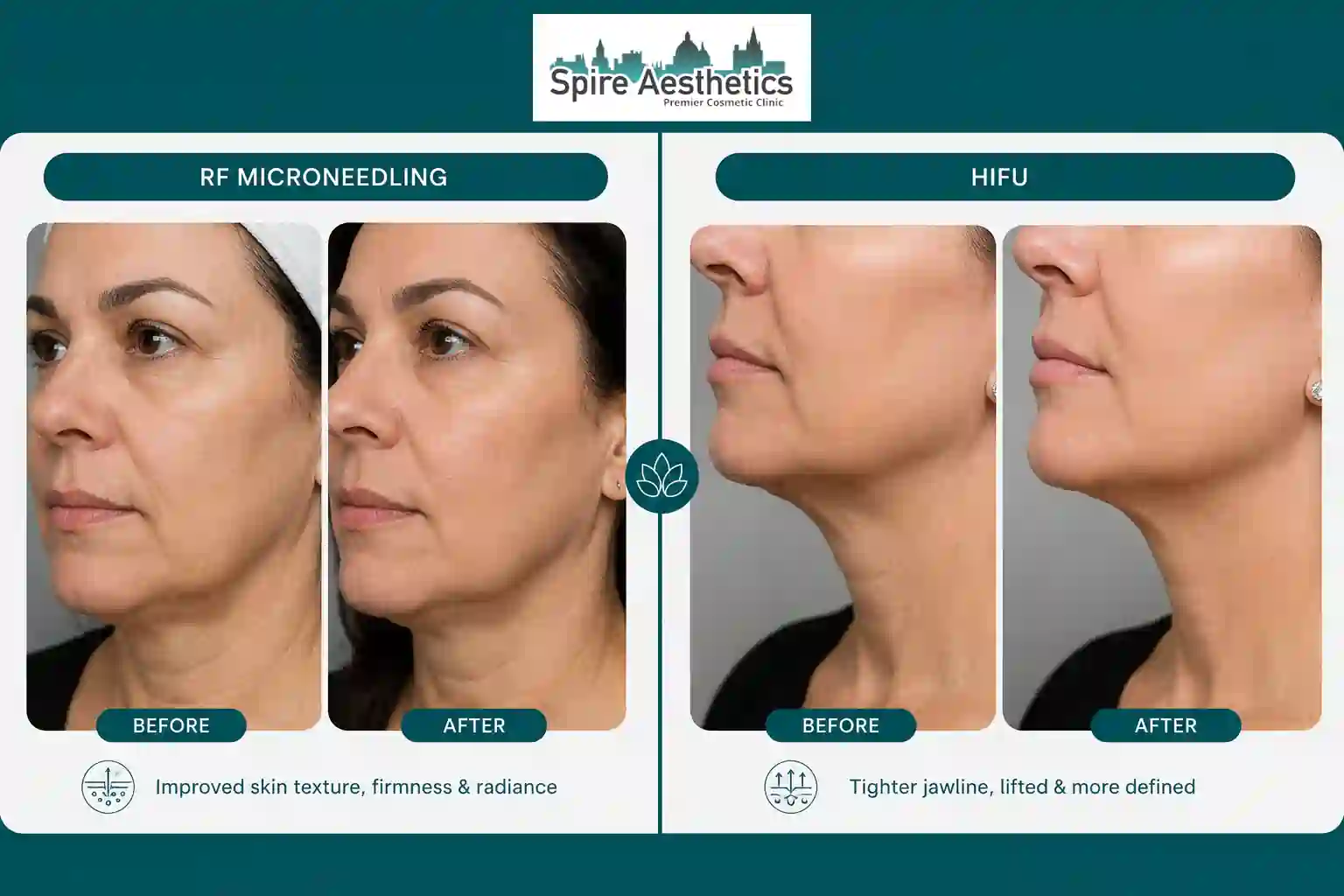 Can RF Microneedling and HIFU Be Combined Rayleigh?