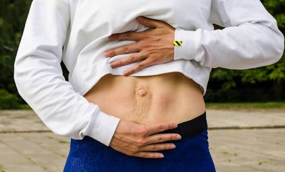 When Could Diastasis Recti Be the Missing Piece of the Puzzle Rayleigh?