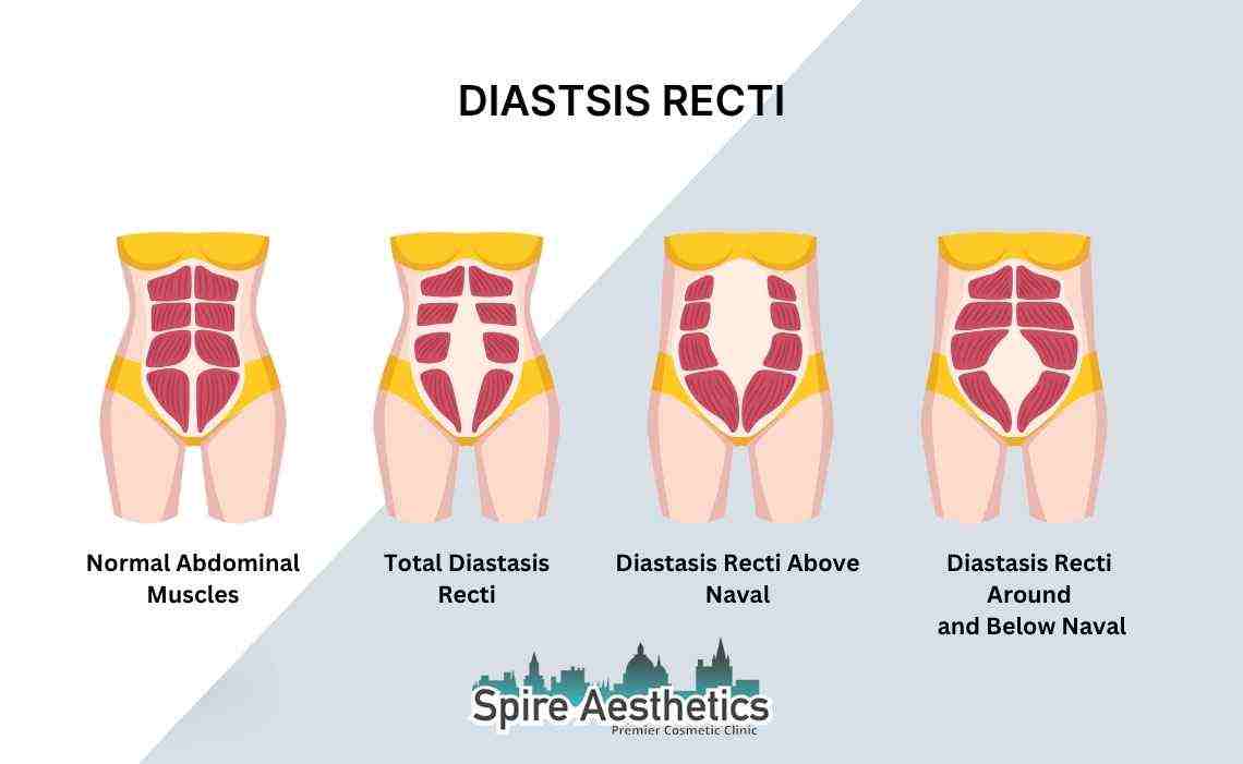 Is Non-Surgical Diastasis Recti Treatment Right for You? Common Concerns Answered Rayleigh